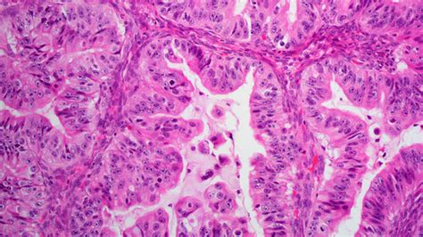 Types Of Ovarian Tumors Ovarian Cancer Johns Hopkins Pathology 2022