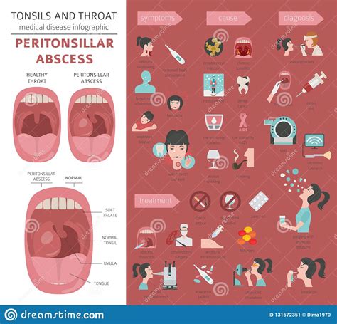 Tonsils And Throat Diseases Peritonsillar Abscess Symptoms Treatment