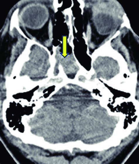 Ct Scan Of The Nasopharynx And Neck Showing A Mass At The Nasopharynx