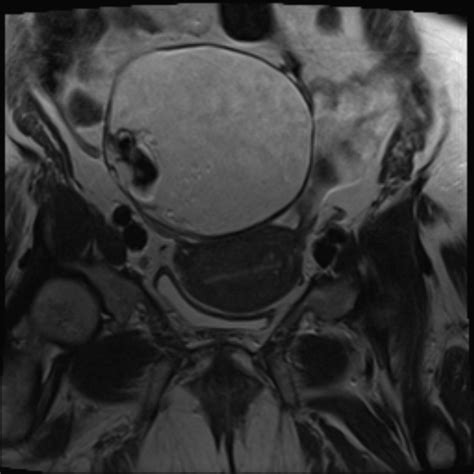 Ovarian Mature Cystic Teratoma Image Radiopaedia Org