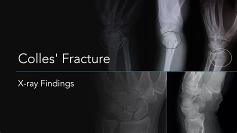 Colles Fracture X Ray Findings Youtube