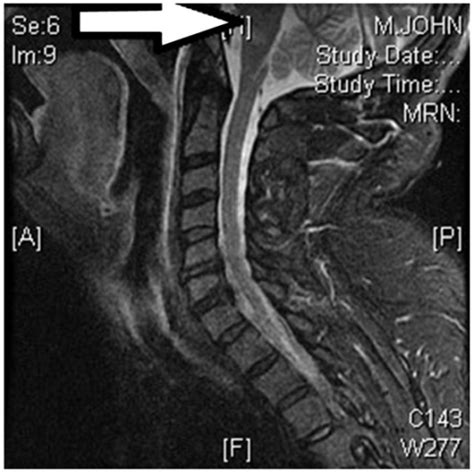 Mri Of Cervical Spine Sagittal Shows Abnormal T2 Hype Open I Free