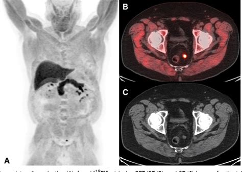 Figure 1 From Lymph Node Dissection Following Radical Prostatectomy