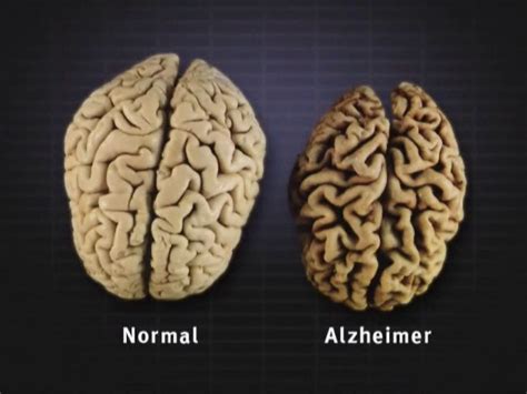 Protein plaques and tangles infiltrate the brain in alzheimer's. Biggest ever map of human Alzheimer's brain - News Article ...