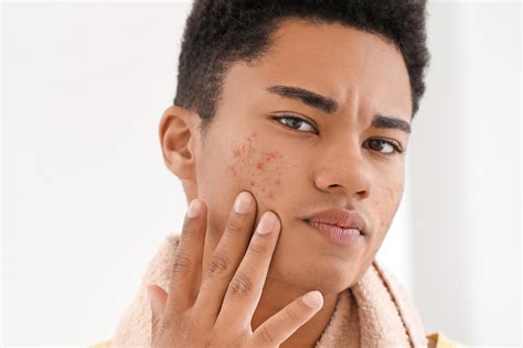 Is It Acne Or Rosacea — Dermatology Of North Asheville