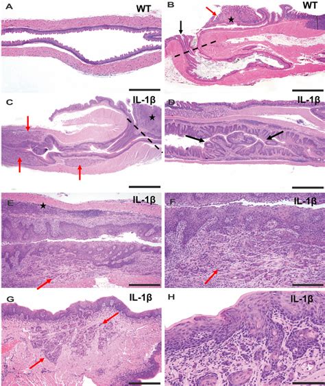 Histopathology Of Esophageal And Tongue Squamous Cell Carcinoma In
