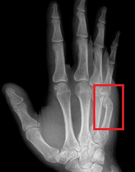 What Is A Boxers Fracture John Erickson Md