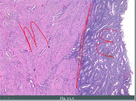 The myometrium stretches and expands to accommodate a growing fetus during pregnancy. Repro: Female pathology: Endometrium, Myometrium ...