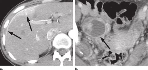 It is an uncommon chronic manifestation of pelvic inflammatory disease affecting women of childbearing age. Fitz-Hugh-Curtis syndrome in a 33-year-old woman with ...