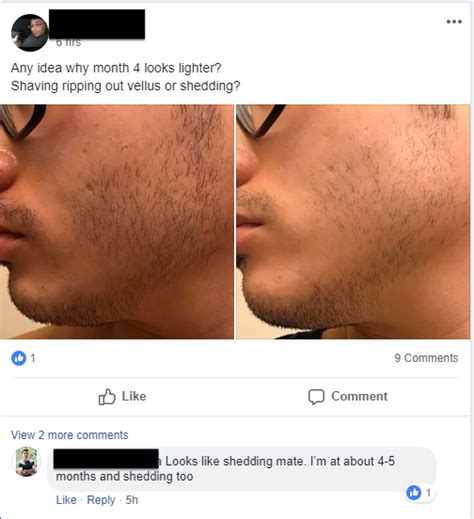 The growth of abdominal hair follows the same pattern on nearly all mammals, vertically from the. The Men Attempting to Grow Thicker Beards With Rogaine