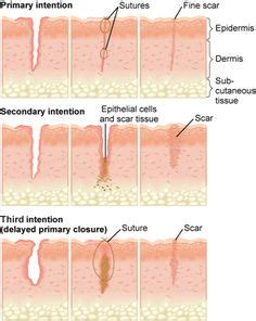 In biology, maceration is used to describe multiple actions. 234 Best Wound care images | Wound care, Nursing notes ...