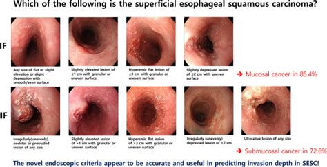 Esophagus Cancer Endoscopy