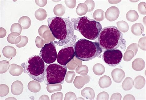 Leukemia Acute Acute Monoblastic And Acute Monocytic