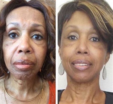 Facial Toning Exercises To Lift Saggy Face Skin And Remove Wrinkles And