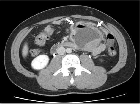 Abdominal CT Finding Showed 9810 Cm Large Mass With Air Fluid Level