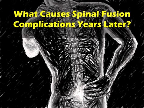 Spinal Fusion Complications Years Later Lumbar Fusion Explained My Xxx Hot Girl