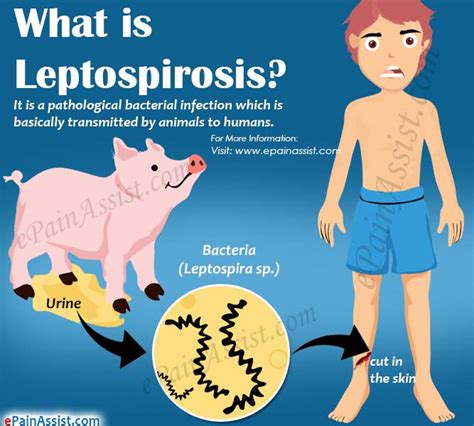 Leptospirosiscausessymptomstreatment