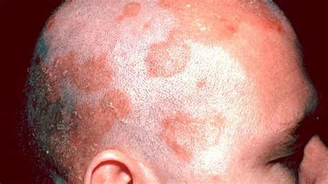 Symptoms Of Seborrheic Dermatitis Youtube