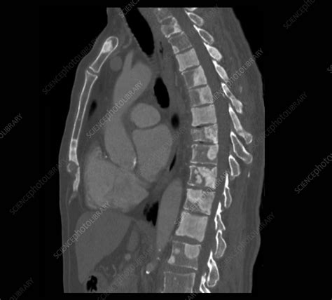 Secondary Bone Cancer In The Spine Ct Scan Stock Image C0469109
