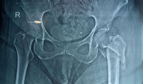Hip Fractures Surgery In Ahmedabad Dr Rachit Sheth