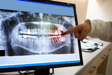 Dental X Rays Uses Types And Risks Safar Medical