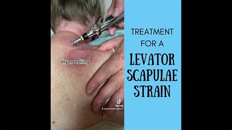 Treatment For Levator Scapulae Strain Youtube