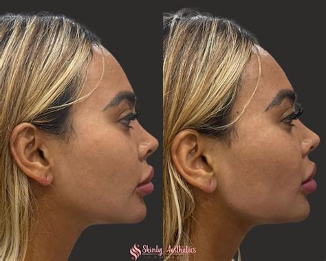Jawline Fillers Before And After Results At Skinly