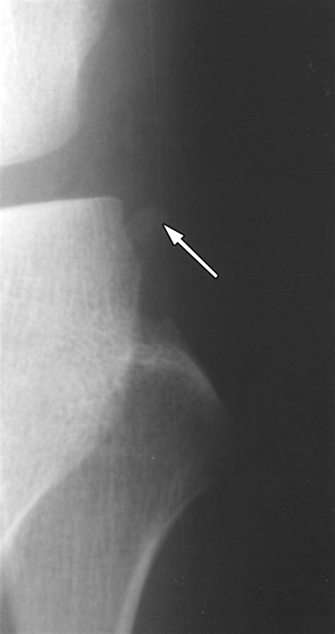 Avulsion Fracture Of The Head Of The Fibula The “arcuate” Sign Mr