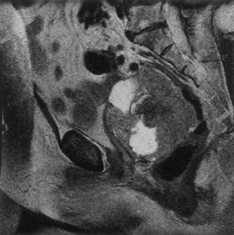 MR Imaging Of Common And Uncommon Large Pelvic Masses RadioGraphics