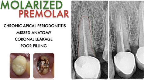 Molarized Premolar Management Of Three Rooted Premolar Style Italiano