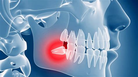 Wisdom Teeth Removal St Louis Midwest Oral Surgery