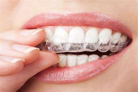 An Invisalign Dentist Takes These Steps To Create The Aligners