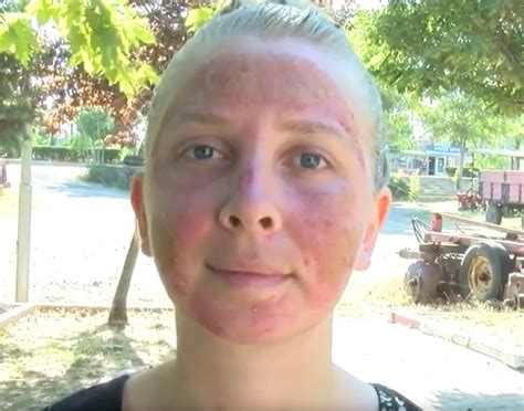 Woman Has Nd Degree Burns On Face After Skin Treatment