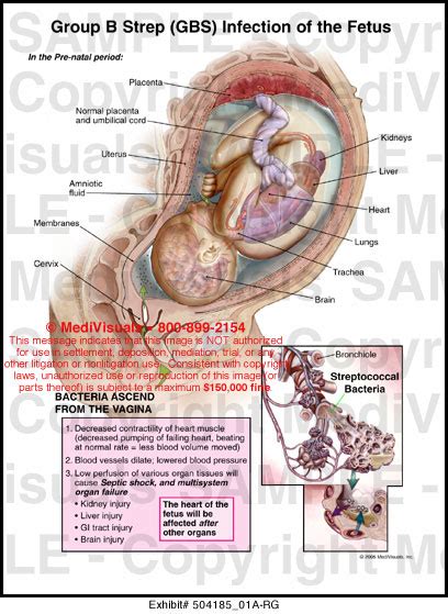 Group B Strep Gbs Infection Of The Fetus Medical Exhibit Medivisuals