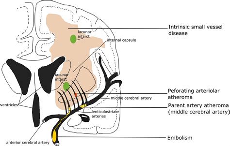 Lacunar Stroke Definition Causes Symptoms Diagnosis Prognosis Treatment