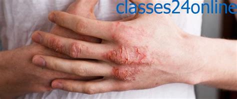 Atopic Dermatitis Eczema Symptoms Causes And Treatment