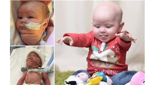 Miracle Baby Survives Cancer While Still In Her Mothers Womb Had