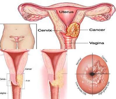 Nyeri saat menstruasi adalah hal normal yang dialami oleh perempuan. Kanker Serviks Sembuh Dengan Varash Natural Oil