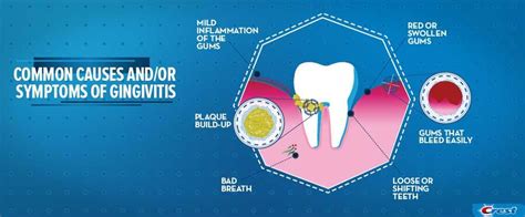What Is Gingivitis Symptoms Causes And Treatments Crest