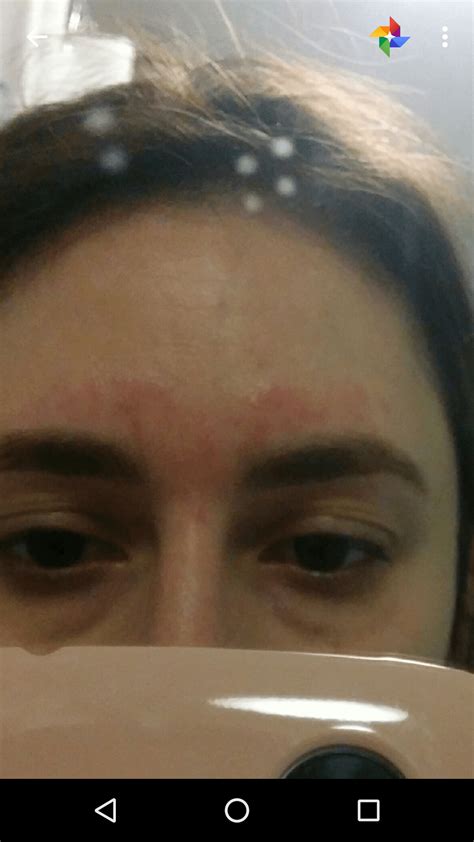 Angry Red Rash The Day After First Eyebrow Wax And Tint Any