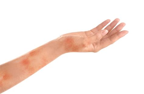 Premium Photo Woman Showing Hand With Dry Skin On White Background