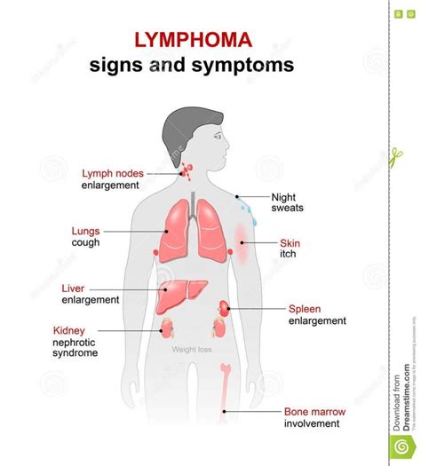 Hodgkins Lymphoma Rash Symptoms