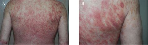 Figure 1 From Drug Induced Lichenoid Dermatitis With Histopathologic
