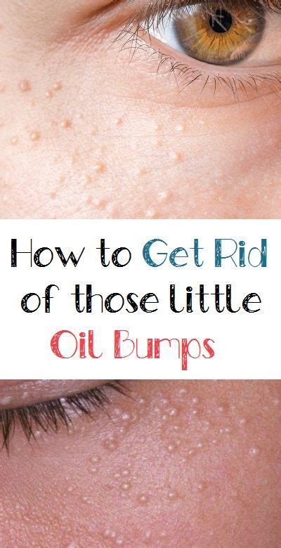 How To Get Rid Of Those Little Oil Bumps On The Face White Bumps On