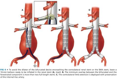 Branched And Fenestrated Endovascular Stent Graft Techniques Thoracic Key