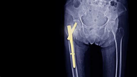 Does The Treatment Of Hip Fractures With Intramedullary Nails Kill