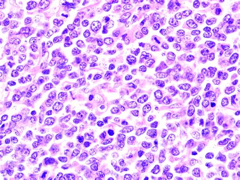 Nodal Aggressive B Cell Lymphomas A Diagnostic Approach Journal Of
