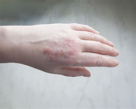 Psoriasis On The Hand Bones Close Up Stock Image Image Of Itching