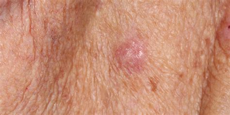 Atypical Fibroxanthoma Afx Skin Cancer And Reconstructive Surgery