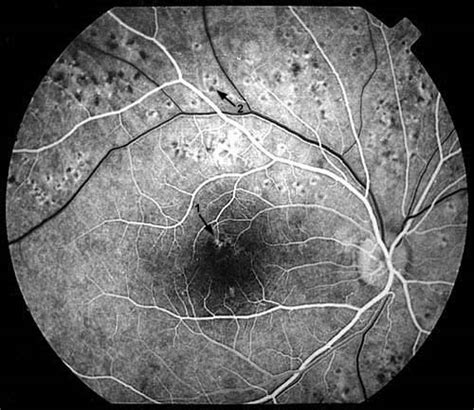 Mam odklejoną siatkówkę oka.szukam fachowca okulistę który podjął by się przyklejenia siatkówki,dowiedziałam sie od. Retinopatia cukrzycowa przedproliferacyjna w obu oczach ...